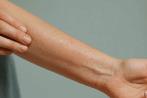 Jaki lek na atopowe zapalenie skóry pomaga w złagodzeniu świądu?